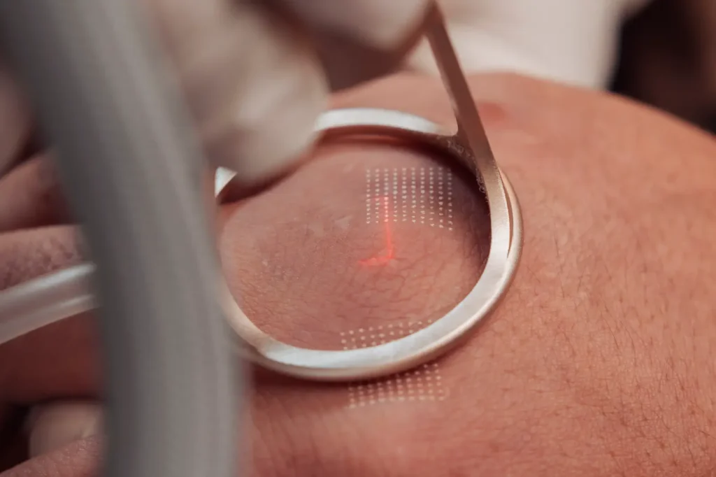 Close-up of a laser device positioned over skin with a circular metal guide and visible targeting pattern.